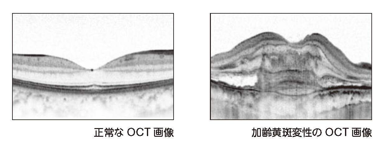 加齢黄斑変性 2 医療法人 中村眼科