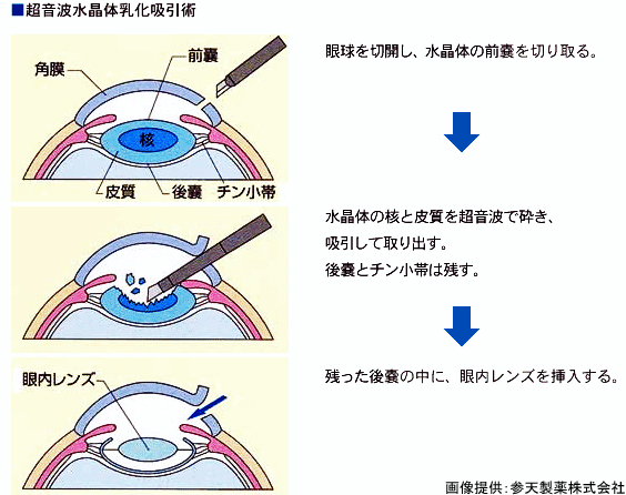 白内障 手術 した 人 の ブログ