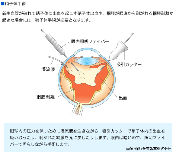 網膜 剥離 原因