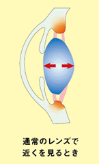 MCレンズの近視進行抑制-通常のレンズで近くを見ているとき