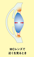 MCレンズの近視進行抑制-MCレンズで近くを見ているとき