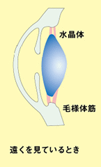 MCレンズの近視進行抑制-遠くを見ているとき